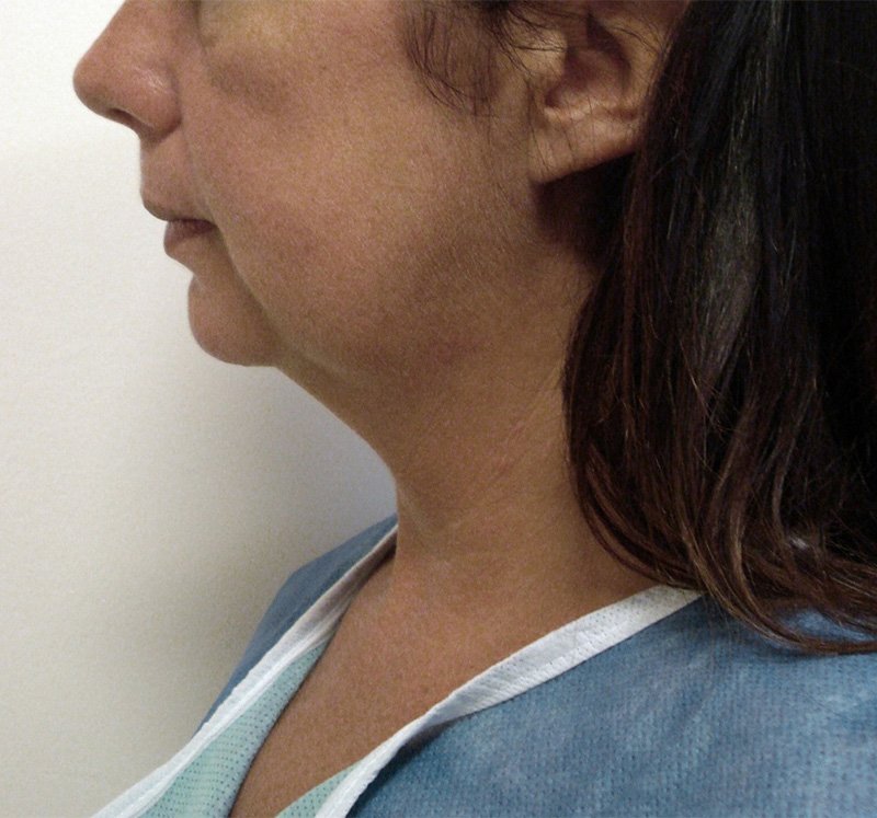 endolift-antes-papada.jpg