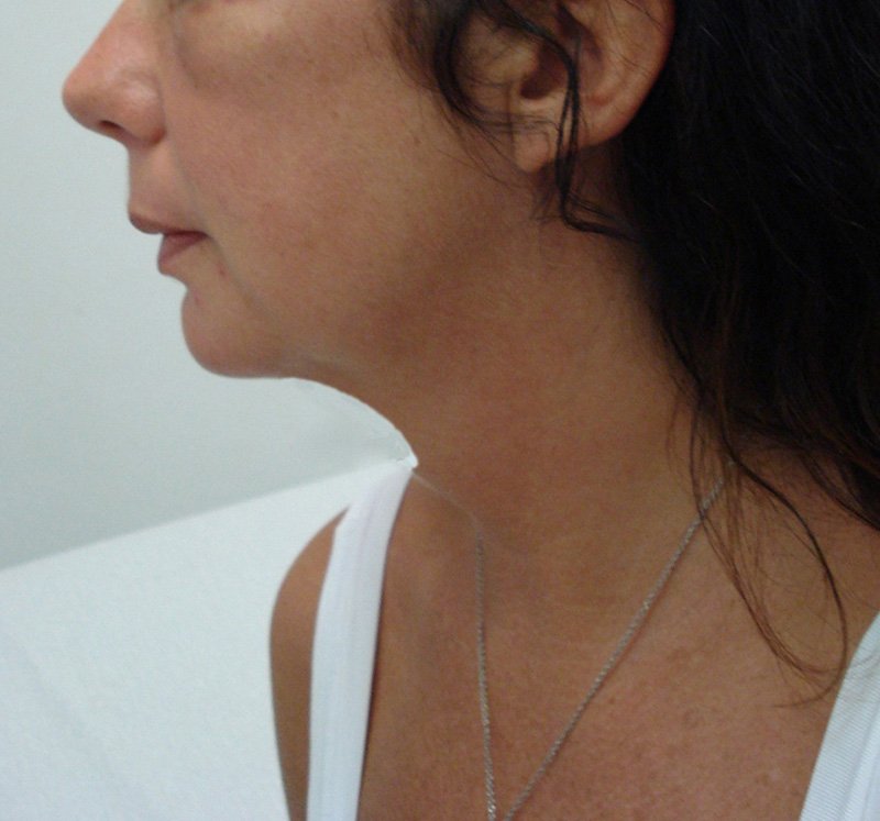 endolift-despues-papada.jpg